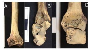 Khám phá xương rỗ Nubian cổ đại và bệnh viêm khớp dạng thấp